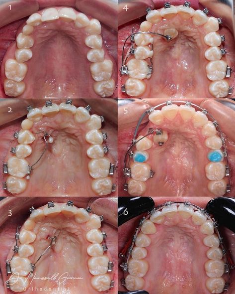 Ortho : impacted canine Orthodontics Teeth, Medical Quotes, Teeth Art, Dental Anatomy, Orthodontics Braces, Dental Braces, Dental School, Teeth Care, Dental Assistant