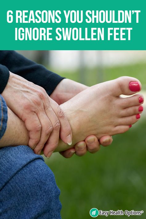 Swollen Hands, Natural Remedies For Migraines, Swollen Ankles, Swollen Legs, Dry Skin Remedies, Cold Home Remedies, Leg Pain, Foot Pain, Body Hair