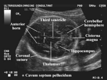 Sonography. Ultrasound. Head Fetal Ultrasound, Diagnostic Medical Sonography Student, Ultrasound School, Ultrasound Physics, Obstetric Ultrasound, Sonography Student, Ultrasound Sonography, Medical Ultrasound, Diagnostic Medical Sonography