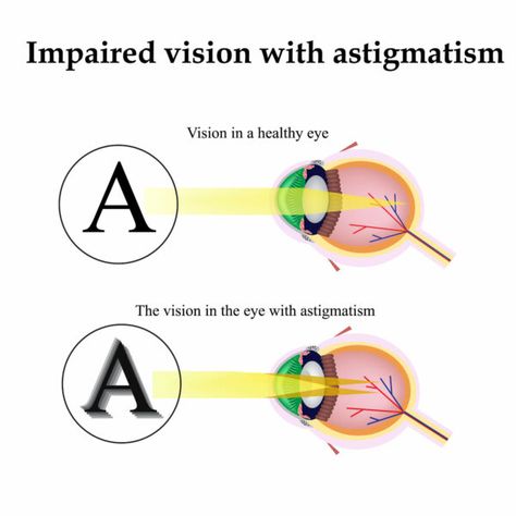 Astigmatism Eye, Vision Training, Eye Problems, Vision Therapy, Vision Health, Slow Aging, Eye Sight Improvement, Eye Exercises, Vision Eye