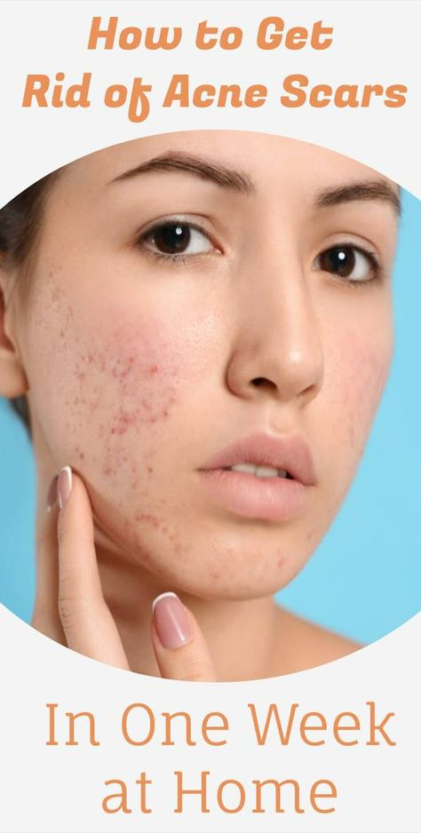 How to Get Rid of Acne Scars in One Week at Home Nails Remedies, Acne Face Map, Acne Scar Remedies, Face Map, Back Acne Remedies, Getting Rid Of Scars, Scar Remedies, Pimple Scars, Acne Prone Skin Care