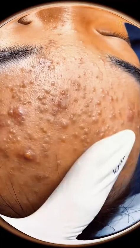 Watch satisfying videos of pimples being popped and extracted. #pimplepopping #popping #satisfying #gross How To Prevent Blackheads, Blackhead Extraction, Mild Acne, Pimples Under The Skin, Black Head Remover Mask, Blackhead Mask, Blackhead Removal, Types Of Acne, Remove Blackheads