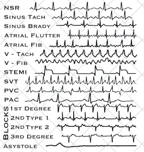 EKG Strips SVG Cardiac Monitor Nurse, Technician, Doctor Gift Digital Download - Etsy Cardiac Technician, Nursing Cardiac, Cardiac Nurse Aesthetic, Cardiac Nurse, Ekg Technician, Gifts For Nursing Students, Cardiac Drips Cheat Sheets, Cardiac Dysrhythmias Cheat Sheets, Cardiac Arrhythmias Nursing