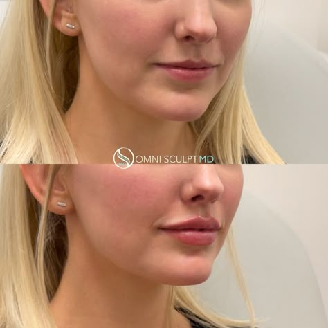 Lip fillers enhance the lips for a fuller, more youthful look. At OMNI SCULPT MD in Dallas, TX we offer many lip fillers, including Juvederm and Restylane. Lip Filler Minimal, Simple Lip Injections, Lip Filler 5ml, Good Lip Filler Pictures, Very Natural Lip Filler, Small Lip Injections Before And After, Simple Lip Fillers, Mild Lip Filler, Lip Filler For Small Lips