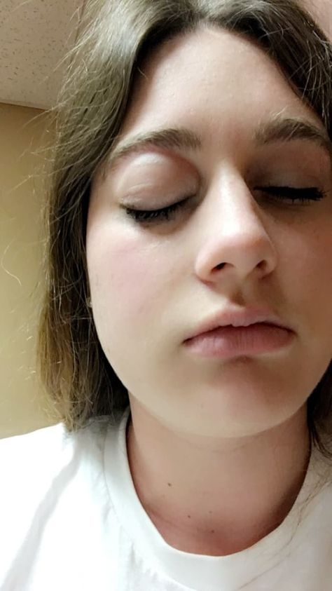 This Woman's Face And Throat Swelled After Eating A Nut Under A Doctor's Supervision Food Allergies Awareness, Allergy Awareness, College Student, Food Allergies, Get Healthy, Woman Face, Allergies, Workout Videos, Nuts