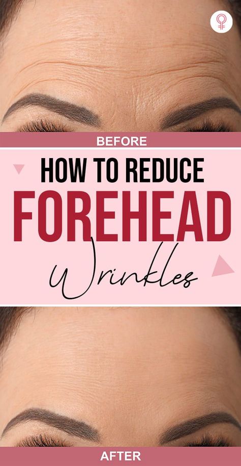 Reduce Forehead Wrinkles, Gallbladder Removal, Wrinkle Remedies, Wrinkle Free Skin, Forehead Wrinkles, Skin Care Wrinkles, Face Wrinkles, Unwanted Hair Removal, Prevent Wrinkles