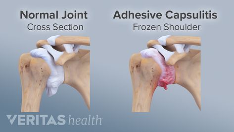 Frozen Shoulder Pain, Frozen Shoulder Exercises, Back Pain Relief Exercises, Shoulder Anatomy, Shoulder Impingement, Nerve Health, Shoulder Exercises, Exercises At Home, Physical Therapy Exercises