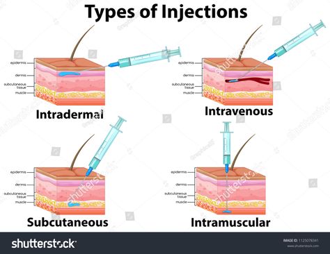 A Set of Type of Injections illustration #Ad , #SPONSORED, #Type#Set#illustration#Injections Types Of Injection, Intravenous Injection, Subcutaneous Injection, Medical Assistant Student, Vet Medicine, Nursing Student Tips, Medical School Essentials, Emergency Nursing, Phlebotomy