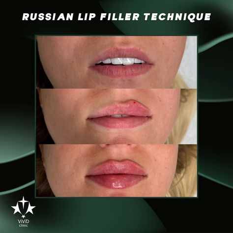 💋✨ Achieve perfectly defined, fuller lips with the Russian Lip Filler Technique at Vivid Clinic! This advanced technique creates beautifully shaped lips with more height and less volume for a natural, elegant pout. 💉 ✅ Focuses on lip height and shape ✅ Creates a subtle, natural-looking pout ✅ Long-lasting, stunning results 💬 Ready to enhance your lips? Book your free consultation today and experience the art of the Russian Lip Filler Technique at Vivid Clinic! 📍Located in Istanbul, Turkey ... Russian Lip Filler Technique, Lip Filler Technique, Russian Lip Filler, Lip Book, Fuller Lips, Lip Filler, Lip Fillers, Istanbul Turkey, Free Consultation