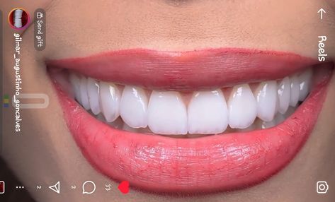 Beautiful Teeth, Teeth Shape, Perfect Teeth, Dental Veneers, White Smile, Perfect Smile, Healthy Smile, Facial, Makeup Looks