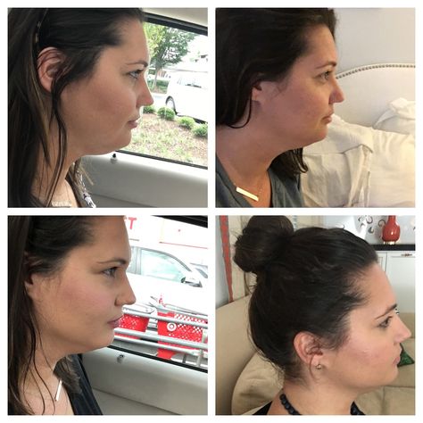 Belkyra Before And After, Kybella Before And After Double Chin, Kybella Before And After, Double Menton, Girl Emoji, Botox Fillers, Intelligent Women, Cosmetic Treatments, Gobble Gobble