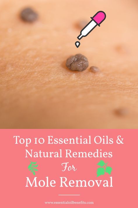 Whether you want to remove a flat or raised mole, find out the best essential oils and natural remedies to remove it naturally at home with no pain or scarring. Essential Oil Wart Remover Recipe, Essential Oils For Wart Removal, Skin Tags Essential Oils, Remove Moles, Skin Care Routine For 20s, Mole Removal, Skin Tags, Natural Healing Remedies, Essential Oils For Skin