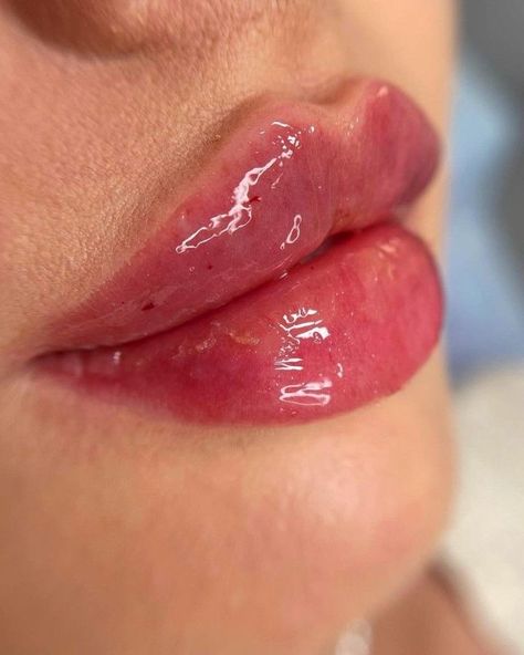 Naturally Bigger Lips, Dream Lips, Dermal Fillers Lips, Ethnic Rhinoplasty, Microbiology Lab, Lips Inspiration, Star Face, Nice Lips, Facial Aesthetics