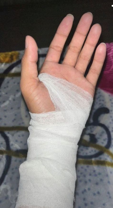 Fake Wounds Photo Hand, Hat Kata Pic Real, Hat Kata Pic Real Blad, Accident Snap Ideas Hand, Fake Hand Scratch Snap, Bandage Snap, Fractured Hand Pic, Hat Kata Pic, Burned Hand Pic