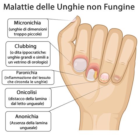 fungal nail pedicure Nail Disorders, Nail Tech School, Nail Art Courses, Nail Infection, Nail Courses, Fungal Nail, School Nails, Beauty Therapy, Nail Health