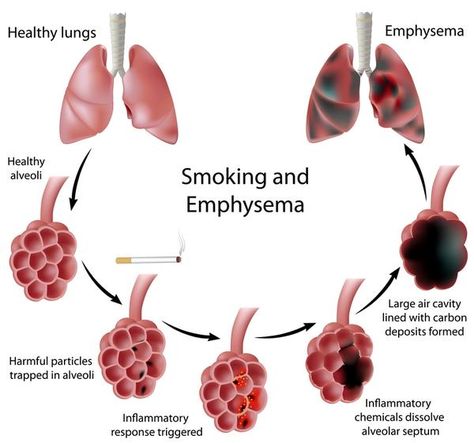 After Quitting Smoking How to Clean Lungs to Achieve Perfect Health Smokers Lungs, Clean Lungs, Healthy Lungs, Pulmonary Disease, Lung Disease, Respiratory System, Lungs, Respiratory, Human Body