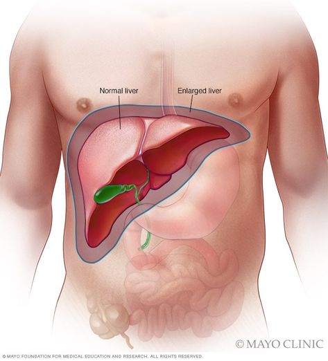 Enlarged Liver, Longevity Diet, Liver Care, Liver Issues, Liver Failure, Body Organs, Mayo Clinic, Abdominal Pain, Health Facts