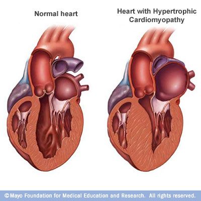 A normal heart (left) and a heart with hypertrophic cardiomyopathy (HCM). Note that the heart walls (muscle) are much thicker (hypertrophied) in the #HCM heart. Chd Awareness, Normal Heart, Congenital Heart Defect, Cardiac Nursing, Heart Defect, Congenital Heart, Heart Care, Heart Muscle, Heart Conditions