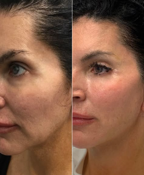 Our lovely patient looks more young  and rested after volume restoration & lower face lift with threads. Way to get natural results nonsurgically Lower Face Lift, Thread Lift Face, Face Plastic Surgery, Face Threading, Derma Facial, Facial Procedure, Face Fillers, Face Surgery, Face Lift Surgery