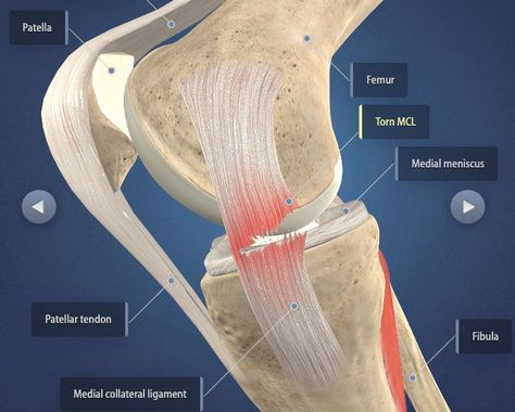 The Do's and Don'ts After ACL & MCL Tears & Surgery | Heiden Orthopedics Acl Tear Symptoms, Meniscus Surgery Recovery, Acl Tear Recovery, Medial Knee Pain, Acl Surgery Recovery, Mcl Injury, Common Knee Injuries, Meniscus Surgery, Acl Knee