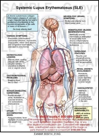 Lupus symptoms Lipoma Removal, Invisible Disease, Sjogrens Syndrome, Autoimmune Disorder, The Human Body, Autoimmune Disease, Don't Judge, Chronic Illness, Anatomy