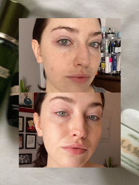 Acne skincare routine