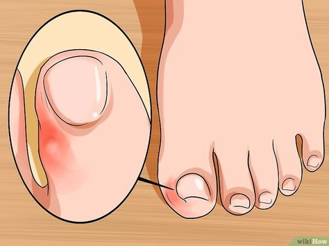 5 Ways to Relieve Ingrown Toe Nail Pain - wikiHow Toenail Pain, Infected Toenail, Nail Fungus Remedy, Ingrown Toenail, Nail Infection, Nail Soak, Ingrown Nail, Matte Nail Polish, Ingrown Toe Nail