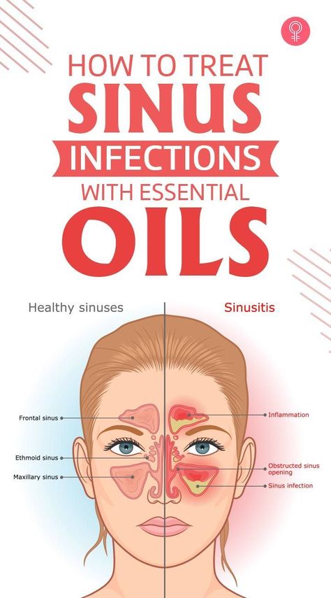 Essential Oil For Sinus Pressure, How To Get Rid Of A Sinus Infection, Essential Oils For Sinus Relief, How To Get Rid Of Sinus Pressure, Diy Sinus Pressure Relief, Remedy For Sinus Infection, Essential Oils For Sinus Infection, Sinus Infection Relief Essential Oils, Get Rid Of Sinus Infection Fast