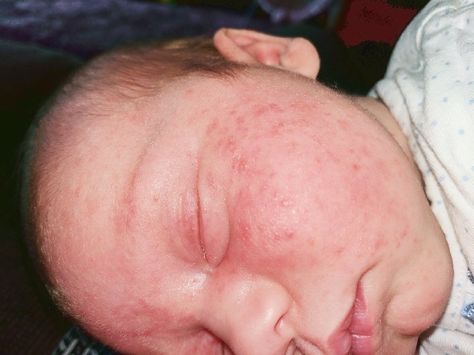 CMPA Rash Symptoms: Advice From a Mum Who's Lived It Milk Allergy Baby, Milk Allergy Symptoms, Distended Stomach, Cows Milk Protein Allergy, Allergy Rash, Cows Milk Allergy, Rash On Face, Baby Acne, Dairy Allergy