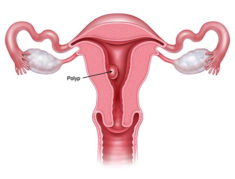 Polyps Uterus, Bicornuate Uterus, Endometrial Polyps, Uterine Polyps, Doctor Office Design, Low Oxalate Diet, Chronic Cough, Fertility Health, Human Anatomy And Physiology