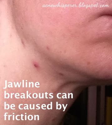 Neck Acne Causes, Deep Pimple, Jawline Acne, Neck Acne, Painful Acne, Pimple Causes, Cystic Pimple, Prevent Pimples, Skin Bumps