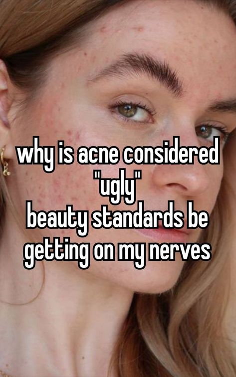 Acne Is Beautiful Quotes, Pretty People With Acne, Acne Aesthetic, Acne Positivity Quotes, Quotes About Acne Positivity, Acne Is Normal Quotes, Acne Positivity, Girl With Acne Aesthetic, Acne Girls Pretty