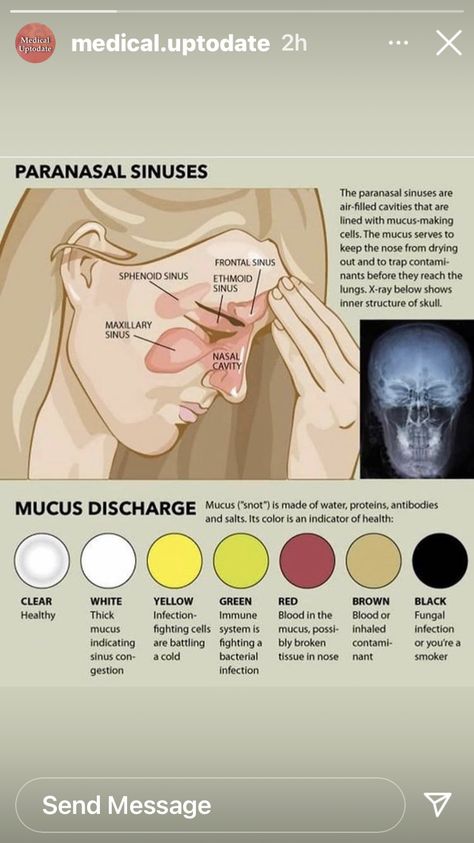 Sinus Blocked Nose, Sinusitis Meme Funny, Clear Your Sinuses, Paranasal Sinuses, Maxillary Sinus, Sinus Cavities, Sinus Problems, Nasal Cavity, Summer Health