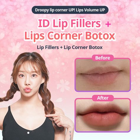 Using lip fillers, we strategically add volume to your lips. With lips corner botox, droopy lip corners are lifted to a youthful smile. #idhospitalkorea #koreanplasticsurgery #plasticsurgery #plasticsurgerykorea #cosmeticsurgery #seoul #korea #IDtransformation #IDbeforeandafter #plasticsurgerybeforeandafter #beforeandafter #beforeandaftersurgery #besttransformation #lipfiller #fillers #fillersinjection #hyaluronicacid #yvoire #juvederm #restylane #restyle #botox #botoxfiller #botoxinjections Lip Filler Korea, Korean Lip Surgery, Korean Lip Filler Before And After, Korean Cherry Lips Filler, Wonyoung Lip Filler, Lip Corner Lift, Korean Lip Filler, Face Massages, Dermal Fillers Lips