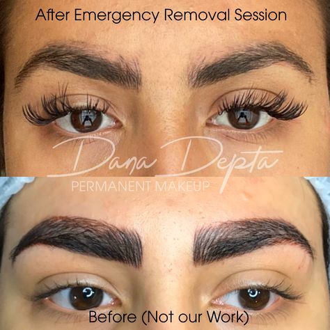 If you got really bad eyebrows, get them removed right away! Emergency removals can be done up to 48 hours after.  #microbladingremoval #microbladingremovallondon #permanentmakeupremoval #smipermanentmakeupremoval #eyebrowtattooremoval Eyebrow Fail, Bad Microblading, Tinted Eyebrows, Permanent Makeup Removal, Eyebrow Tattoo Removal, Tattoo Removal Laser, Makeup Fail, Ombre Eyebrows, Bad Eyebrows