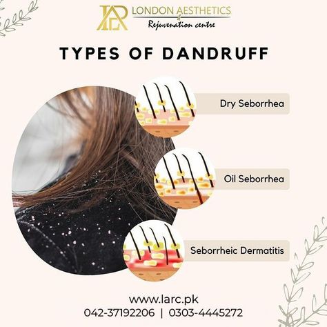 Suffering from chronic dandruff? No Worries! Stop stressing and start recovering with our vast range of treatments for all the 3 types of chronic dandruff: ✔️ Seborrheic Dermatitis A severe form of oily skin dandruff. Your scalp feels as if it's on fire! ✔️ Oily Skin Dandruff When the surface of your scalp and hair is greasy and oily with an unpleasant odour. ✔️ Dry Skin Dandruff This is when the surface of your scalp and hair is dry and flaky and the skin is red and itchy. Stop Stressing, Oily Scalp, Itchy Scalp, Dandruff, Dry Hair, On Fire, Oily Skin, The 3, Dry Skin