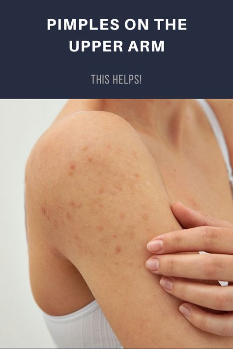 Arm Pimples, Arm Acne, Body Pimples, Back Pimples, Get Rid Of Pimples, Rid Of Pimples, Pimples Under The Skin, Prevent Pimples, Natural Acne Remedies