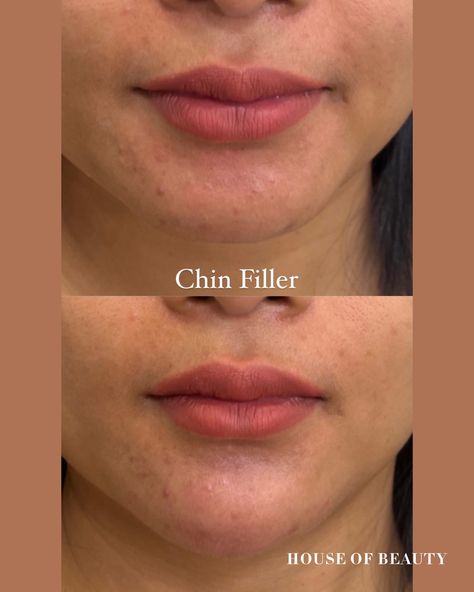 Chin filler House of Beauty Camberley Chin And Jawline Fillers, Jaw Filler, Facial Harmony, Chin Filler, Facial Structure, Hyaluronic Acid Fillers, Clean Blackheads, Botox Fillers, House Of Beauty