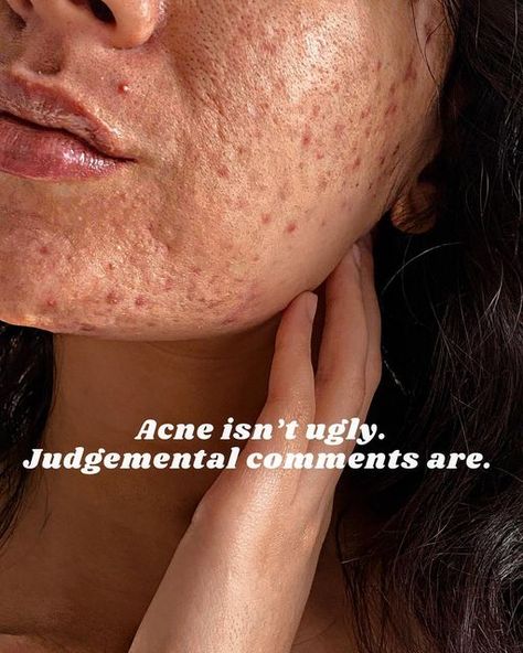 Acne Photos, Girl With Acne, Forehead Acne, Natural Acne Remedies, How To Get Rid Of Pimples, Face Acne, Acne Remedies, Acne Marks, Acne Skin