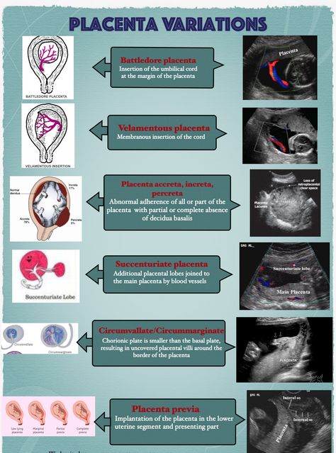 placenta  ultrasound Ultrasound Notes Study, Sonography Notes Ultrasound, Ultrasound Technician Aesthetic Notes, Diagnostic Medical Sonography Student Notes, Ultrasound Technician Notes, Sonography Student Notes, Ultrasound Tech Study Notes, Black Ultrasound Technician, Ultrasound Technician Student Notes