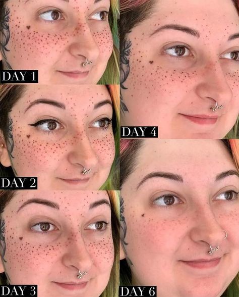 Freckle Tattoo Healing and Aftercare - Ultimate Guide Stick And Poke Freckles, Healed Freckle Tattoo, Faux Freckles Tattoo, Constellation Freckle Tattoo, Tattoo Freckles Before And After, Chest Freckles, Pmu Freckles, Star Freckle Tattoo, Rainbow Freckles Tattoo