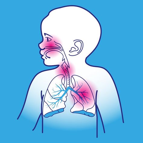 Is croup contagious? Understand how croup spreads, its symptoms, and potential risks. Get clear insights on croup's contagious nature. - #Cancroupspread? #closecontacttransmission #contagiouscroupsymptoms #contagiousphaserecognition #croupinfection #croupspreading #crouptransmission #Croup:Howcontagious?. #Doescrouptransmit? #earlytransmissiondetection #Iscroupcommunicable? #Iscroupinfectious? #respiratorydropletsspread #viralcontagionrisks Baby Nasal Congestion, Upper Respiratory Tract, Data Patterns, Bad Cough, Upper Respiratory Infection, Target Kids, Cat Spray, Respiratory Infection, Cold Cough