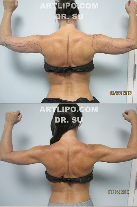 Sexy, Beautiful, Toned Arms in ONE Day, No working out! New Revolutionary Arm Liposuction procedure exclusively by innovator DrSu at #Artlipo! CALL us TODAY ☎️813-886-9090 or visit Artlipo.com to schedule a complimentary consultation! Arm-Lift-Liposuction-Tampa-Sarasota-Orlando. Tighten Stomach Skin, Celebrity Arms, Tighten Stomach, Skin Firming Lotion, Saggy Neck, Skin Tightening Stomach, Tighten Loose Skin, Skin Bumps, Extra Skin