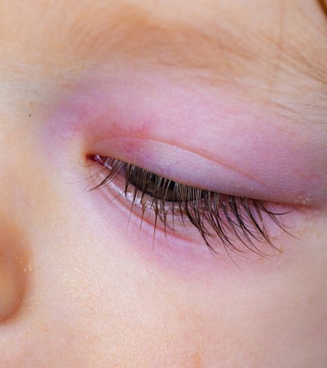 Swollen Eye Remedies, Newborn Baby Eyes, Stye Remedy, Goopy Eyes, Swollen Eyelid, Allergy Eyes, Swollen Face, Natural Remedies For Migraines, Swollen Eyes