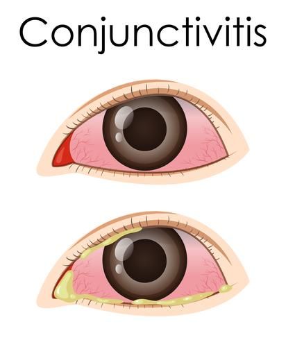 Diagram showing conjunctivitis in human Conjuctivita Eye, Human Vector, New Photos Hd, Pink Eye, Photos Hd, Pink Eyes, Wellness Tips, Baby Showers, To Tell