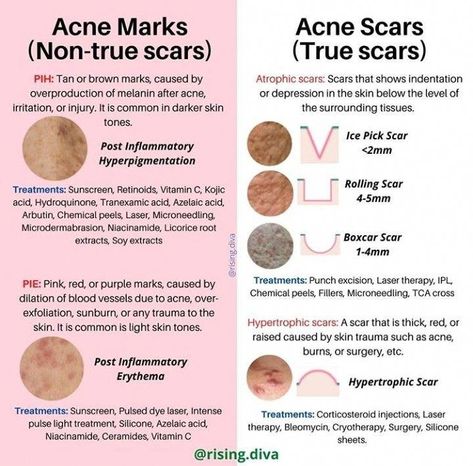 Skin Facts, Skin Moles, Skin Advice, Skin Aesthetics, Types Of Skin, Perfect Skin Care Routine, Healthy Skin Tips, Facial Skin Care Routine, Acne Marks