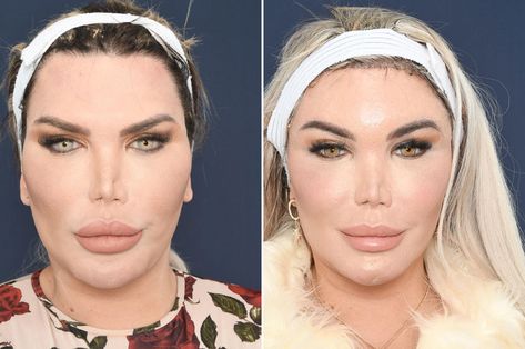 Jessica Alves before and after her Facial Feminization Surgery / FFS Ffs Surgery, Jaw Angle, Surgery Prayer, Chin Surgery, Jessica Alves, Plastic Surgery Gone Wrong, Brow Lift, After Surgery, Feminine Look