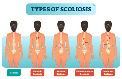 Types of scoliosis Spinal Fusion, Spine Health, Medical Information, Sciatica, Physical Therapy, Back Pain, Yoga Poses, Pilates, Physics