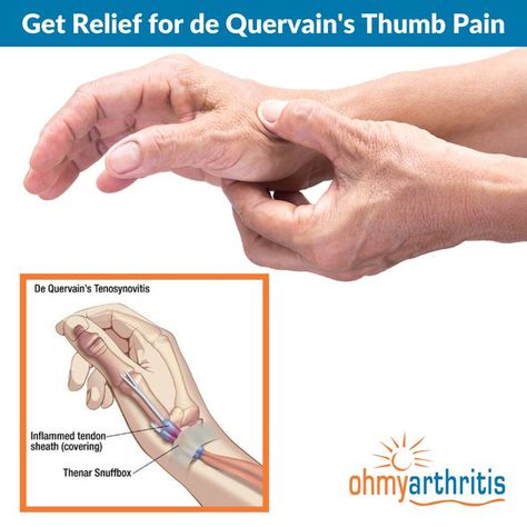 De Quervain's Tenosynovitis, or Mommy's Thumb, is a painful condition caused by inflammation and swelling in the tendons on the thumb side of the wrist and up the side of the forearm. Learn more about this condition and how it can be treated here Thumb Pain Relief, Hand Therapy Exercises, Wrist Pain Relief, Thumb Splint, K Tape, Joints Pain Remedy, Hand Health, Arthritic Pain, Hand Exercises