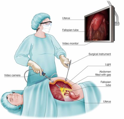 Laparotomy surgery, exploratory laparotomy or open laparotomy procedure Ectopic Pregnancy, Laparoscopic Surgery, Polycystic Ovarian Syndrome, Polycystic Ovaries, Obstetrics And Gynaecology, Medical Knowledge, Surgery, I Hope, Medical